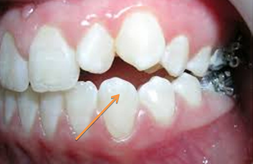 ortodoncia-infantil1